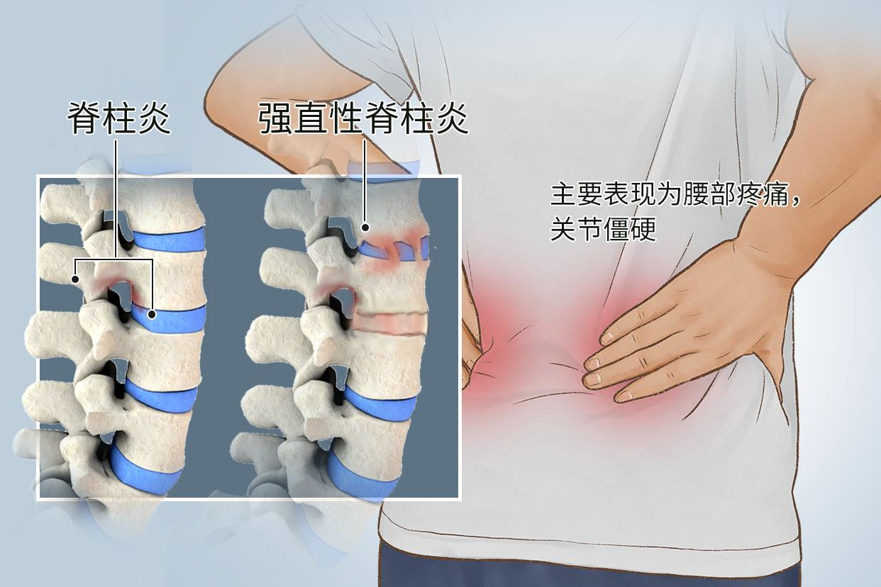 强直34.jpg